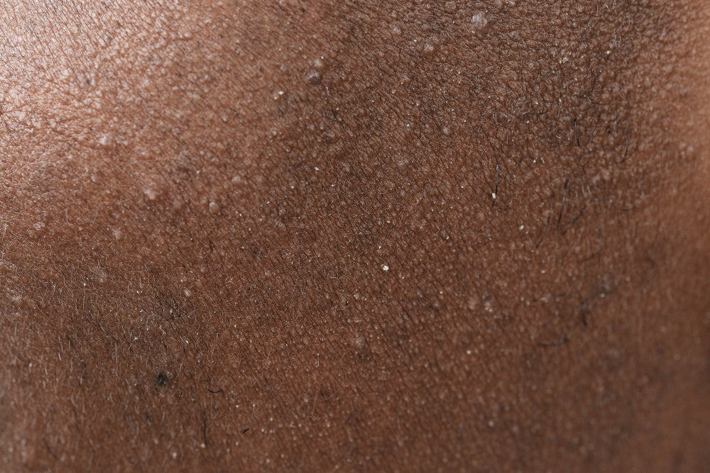 close-up-skin-pores-face-care-routine-with-Acne