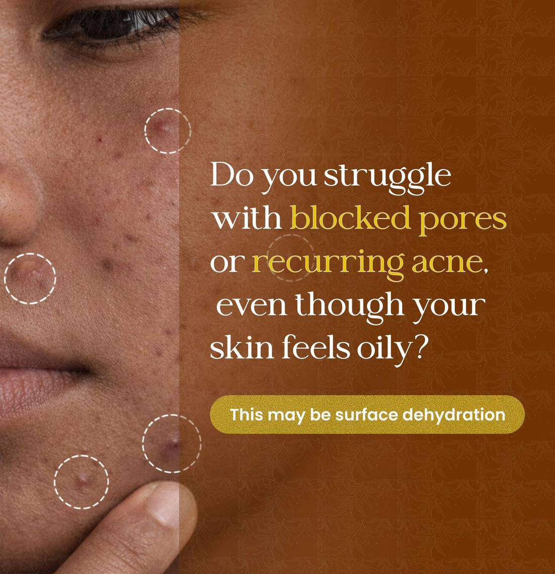 Surface Dehydration: The Hidden Cause of Oiliness, Texture & Dull Skin